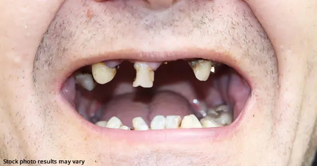 Before full mouth restoration — damaged and missing teeth