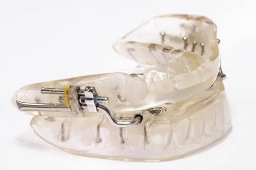 Sleep apnoea oral appliance mouthguard