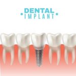 Dental implant