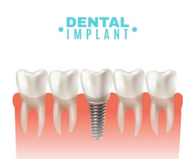 Dental implant