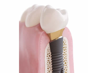 dental implants