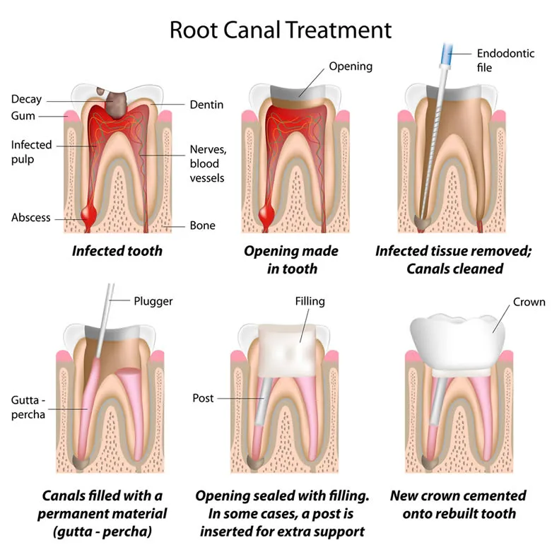 root canal treatment stages